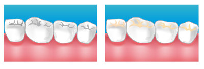 Soins des caries à Saint Geniès de Malgoires